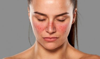 Reumatologista explica como ocorre a doença do lúpus e seus principais sintomas